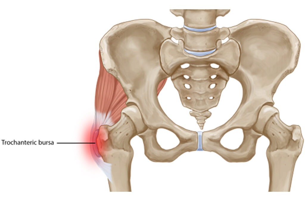 Lateral Hip Pain Trochanteric Bursitis Physiotherapy