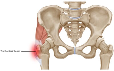 Lateral Hip Pain