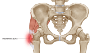 lateral hip pain image