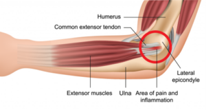 Tennis elbow diagram