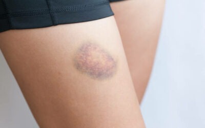 Bruises, Contusions and Hematomas – What’s the Difference?