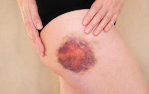 Hematoma on a woman's leg 